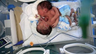 اليونيسيف تنقل توأمين سياميين من اليمن للأردن
