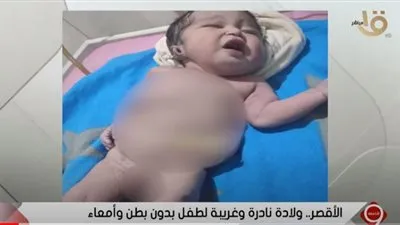 استشاري يكشف سبب ولادة طفل دون بطن وأمعاء بالأقصر (فيديو)