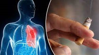 أستاذ حساسية: 85% من سرطان الرئة سببه التدخين (فيديو)