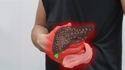 أعراض تدل على الإصابة بفيروس الالتهاب الكبدي 