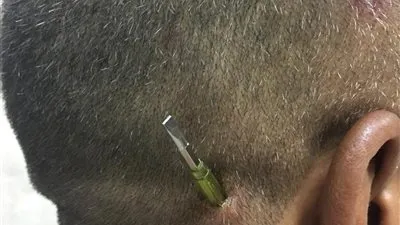 مستشفى سوهاج الجامعي تنجح في استخراج مفك طوله ١٠ سم من رأس مواطن