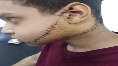 50 غرزة بالوجه والرقبة.. جزاء طالب حاول الصلح بين أصدقائه بالدقهلية