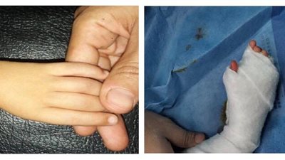 جراحة نادرة.. تحويل إصبع السبابة إلى إبهام بمستشفى جامعة طنطا