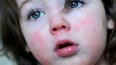 أخصائي طب أطفال تكشف أعراض الإصابة بالحمى الوردية وكيفية علاجها (فيديو)