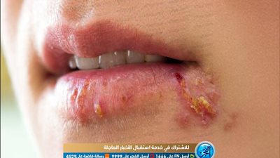 هاني الناظر يكشف أسباب الهربس وطرق الوقاية والعلاج (فيديو)