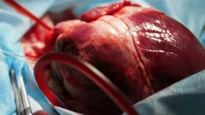 استشاري يكشف عن الحل الأفضل حال انسداد أكثر من شريان في القلب (فيديو)