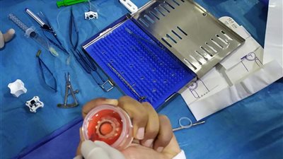  حلم جديد يتحقق لمرضى زراعة القرنية برمد المنصورة 