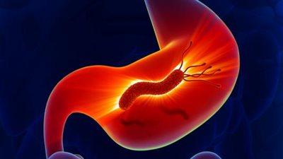 استشاري يكشف أعراض الإصابة بجرثومة المعدة وطرق علاجها (فيديو)