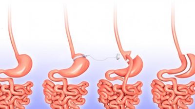 استشاري: عملية تحويل المسار تقلل امتصاص السكريات بنسبة 70%