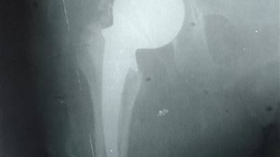 تركيب مفصل صناعي لمريضة تبلغ من العمر 67 عاما بقنا