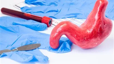 طبيب: عملية تحويل المسار الأصلح لمريض السمنة المحب للحلويات (فيديو)