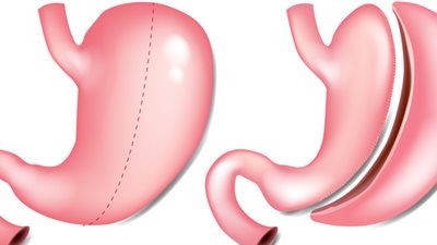 استشاري: عملية تكميم المعدة تستمر العمر كله في هذه الحالة (فيديو)