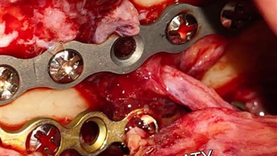 نجاح فريق طبي في تثبيت فك مكسور لشاب بمستشفى السنبلاوين العام بالدقهلية