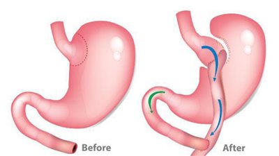 استشاري: عملية تحويل المسار مناسبة لعلاج السكر