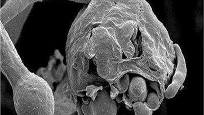 طبيب عيون يكشف تفاصيل جديدة عن الإصابة بالفطر الأسود (فيديو)