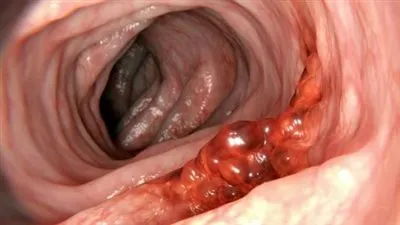 10 أسباب خطيرة لنزول دم مع البراز.. تعرف عليهم