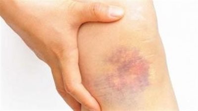 كل ما تريد معرفته عن مرض الهيموفيليا