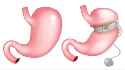 استشاري يُحذر من إجراء عملية حزام المعدة لخفض الوزن