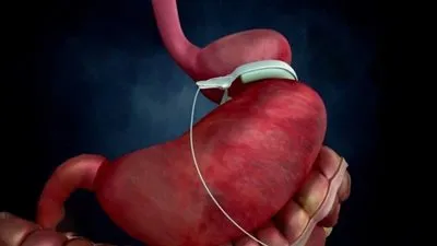 أستاذ جراحة: عملية حزام المعدة لم تعد تجرى حاليا (فيديو)