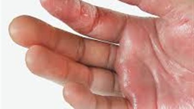 ما هي متلازمة الصدمة التسممية؟.. الأسباب والأعراض والعلاج