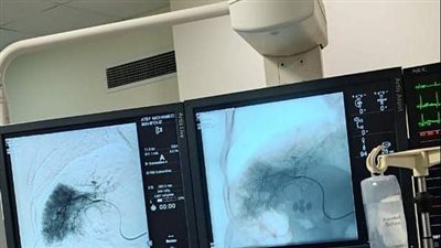 الرعاية الصحية: نجاح علاج ورم بالكبد لمريض باستخدام الحقن الشرياني بالإسماعيلية