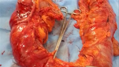 نجاح عملية دقيقة باستئصال كامل للقولون وتحويل مسار لمسن في الدقهلية (صور)