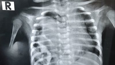 قسطرة مخية لطفلة لفصل ورم بالمخ وإزالته جراحيا بنجاح فى مستشفى أحمد ماهر التعليمى