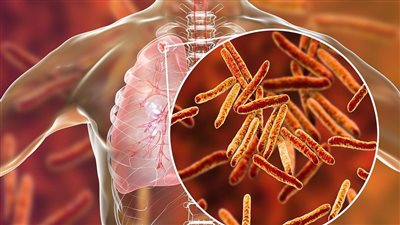 في اليوم العالمي.. حقائق لا تعرفها عن الدرن