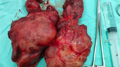 نجاح عملية ىستئصال غدة درقية وزنها كيلوجرام بالإسكندرية 