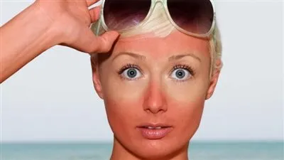 استشاري أمراض جلدية يوجه نصائح للوقاية من حروق الشمس خلال الصيف (فيديو)