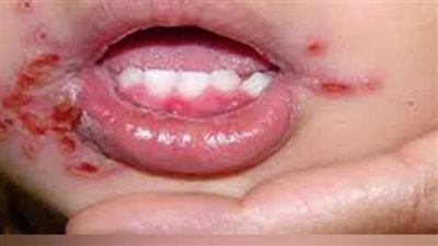 استشاري أطفال يحذر من 