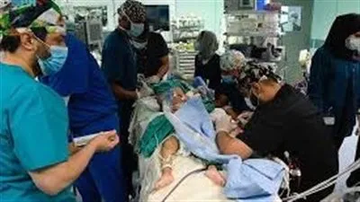 وفاة أحد الطفلين التوأم الملتصق بالرأس باليمن