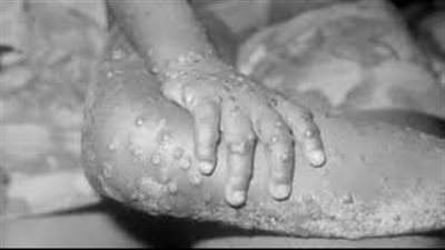 السويد وإيطاليا يعلنا أول إصابة بفيروس جدري القردة القاتل