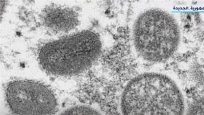 طبيب يكشف علاقة مرض جدري القرود بـ 