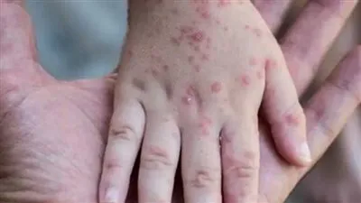 هل وفرت مصر لقاح جدري القرود؟