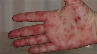 أستاذ طب أطفال يوجه هذه النصائح بشأن 