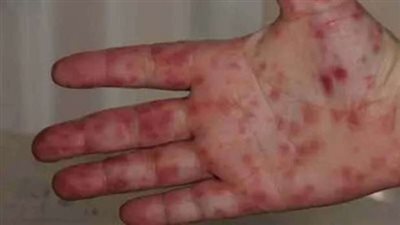 هاني الناظر يكشف حقيقة انتشار أنفلونزا الطماطم وأعراض الإصابة (فيديو)