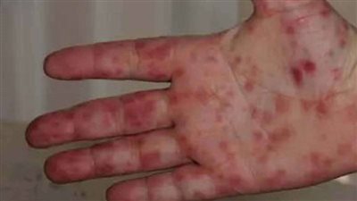 القومي للبحوث يكشف مفاجأة عن إنفلونزا الطماطم (فيديو)