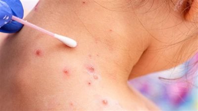 خالد عبدالغفار يزف بشرى سارة عن جدري القرود