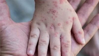 لم يصل مصر حتى الآن.. كيف طمأنت الصحة المواطنين بشأن جدري القرود؟