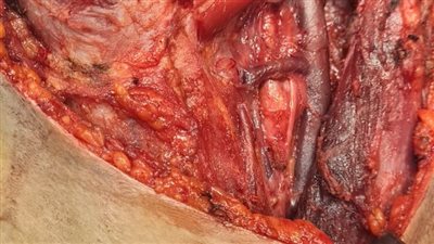  استئصال جذري لورم سرطاني باللسان بأسوان