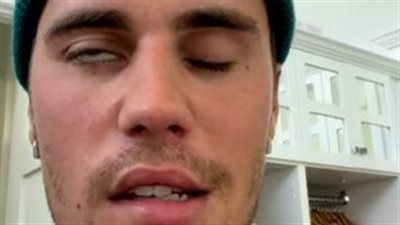 جاستن بيبر يؤجل جولته المتبقية بأمريكا الشمالية بعد إصابته بشلل في وجهه