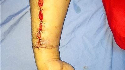 إجراء أول جراحة لتوصيل يد مبتورة بمستشفى بنها الجامعي 