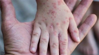 طلب إحاطة بشأن توضيح خطة الحكومة في التصدي لفيروس جدري القرود