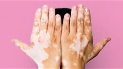 أول علاج لمرض البهاق.. سعره يصل لـ37 ألف جنيه ويحظر استخدامه لهؤلاء