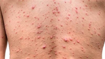 تفشي جدري القرود.. هل يعود العالم للإغلاق بعد إعلان الطوارئ الصحية؟