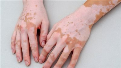 هاني الناظر يكشف تفاصيل العلاج الجديد للبهاق ومدى توافره (فيديو)