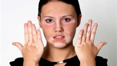 هاني الناظر يكشف تفاصيل العلاج الجديد لمرضى البهاق