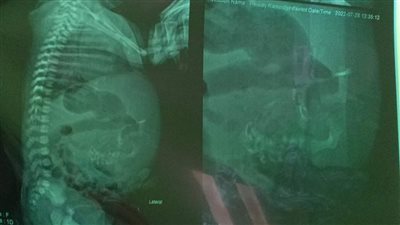 حالة نادرة لطفلة مولودة وفي بطنها اشتباه جنين بمستشفى أطفال المنصورة