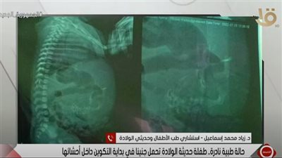 استشاري أطفال بالدقهلية يكشف سر الحالة الطبية النادرة لرضيعة تحمل جنينا بأحشائها